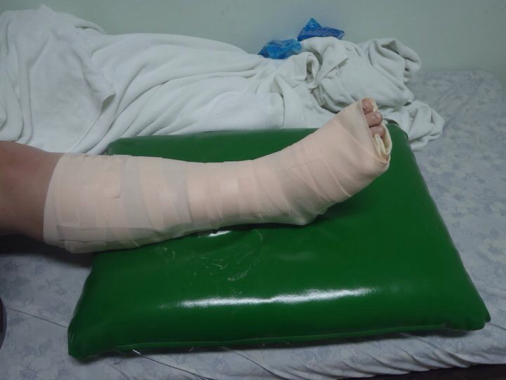 Broken ankle in Thailand